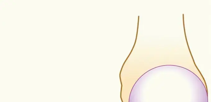 جراحة لاتاريت: حل نهائي لعدم استقرار الكتف الناتج عن فقدان العظم – مع الأستاذ الدكتور محمد هطيف