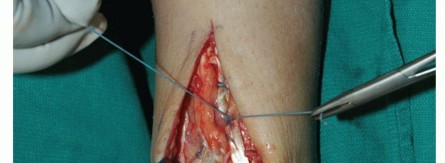 Illustration 61 for Restore Movement: Tendon Transfer for Common Peroneal Nerve Foot Drop