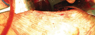 Illustration 55 for Figure Hip Resurfacing: Who Benefits and Who Should Avoid It?