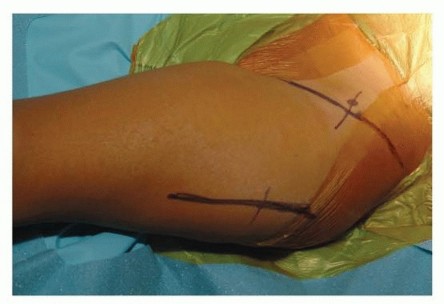 Illustration 9 for Mastering Anterior Open Reduction for Developmentally Dislocated Hip