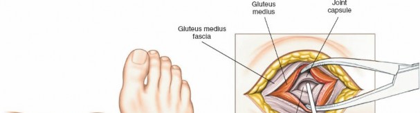 Illustration 74 for Optimal Femoral Approaches: Mastering the Lateral Intermuscular Septum
