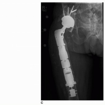 Illustration 42 for Allograft Prosthetic Composite: Mastering Proximal Femur Reconstruction