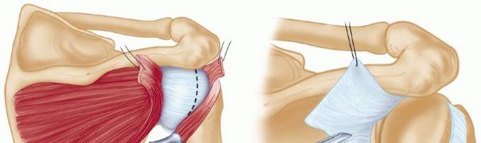 Illustration 16 for Finally Treat Recurrent Posterior Instability of the Shoulder