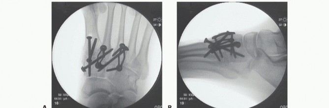 Illustration 35 for Mastering Midfoot Arthrodesis: Protect the Deep Neurovascular Bundle