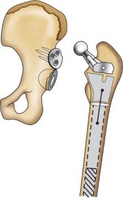 Illustration 131 for Successful Total Hip Replacement in Developmental Dysplasia