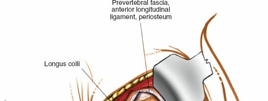 Illustration 255 for Approach to the Lumbar Spine: Mastering Techniques & Anatomy