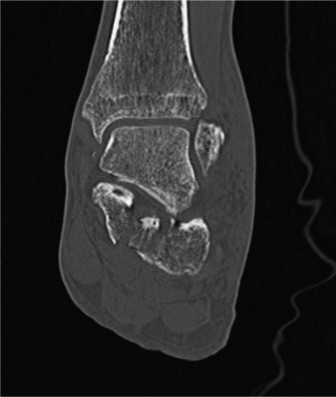 Illustration 2 for Calcaneus Fracture: Mastering Diagnosis at the Point of the Posterior