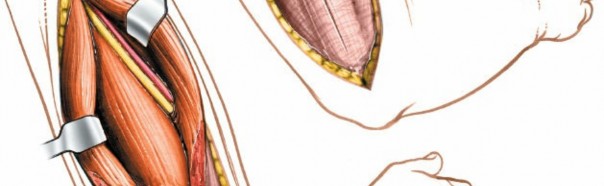 Illustration 42 for Mastering the Approach to the Distal Humerus: Safety & Skills