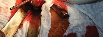 Illustration 52 for Metal on Metal Resurfacing: Enhanced Posterior Soft Tissue Repair