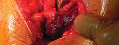 Illustration 35 for Unlock better THA: The technique of short stem for less invasiveness