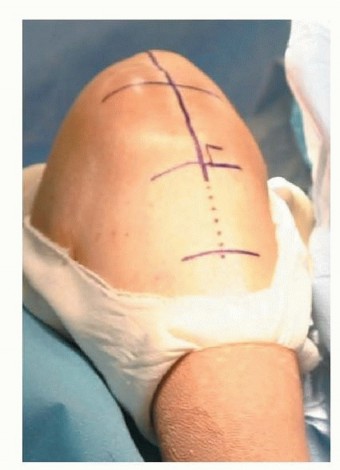 Illustration 2 for Patella Tendon Rupture Reconstruction in Revision TKA