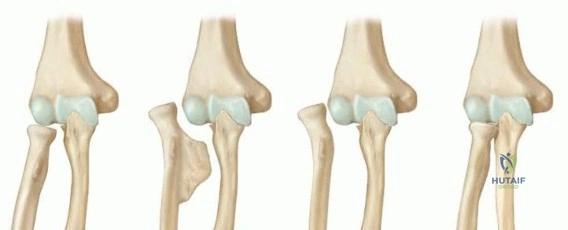 Operative Principles of Lower Extremity Arthrodesis: Ankle and Knee