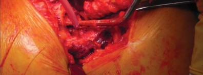 Illustration 28 for Unlock better THA: The technique of short stem for less invasiveness