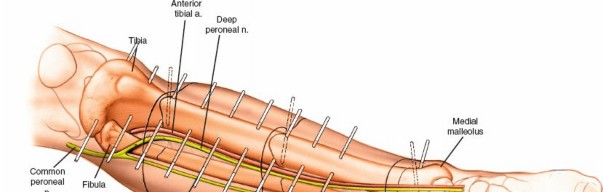 Illustration 36 for Key Approaches for External Fixation: Humerus, Radius, Ulna, Wrist