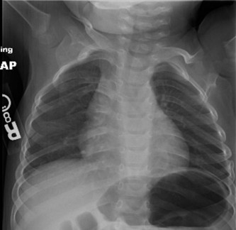 Duchenne Muscular Dystrophy: Orthopedic Management, Early Signs & Surgical Anatomy