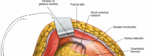 Illustration 178 for Unlocking Every Aspect of the Hip's Surgical Approaches