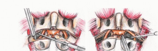 Illustration 37 for Sacral Tumor Surgery: Safeguarding Bowel & Bladder Control