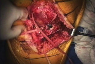 Illustration 11 for Extensor Reconstruction in Total Knee Arthroplasty: Essential Strategies