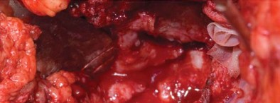 Illustration 49 for Management of Periprosthetic Fractures: An Expert Surgical Guide