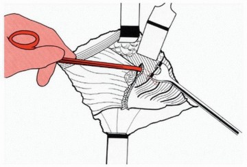 Illustration 22 for Sliding Trochanteric Osteotomy: Modern Role & Refined Techniques
