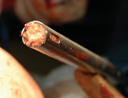 Illustration 85 for Femoral Stem Revision: Posterior Approach for Better Outcomes