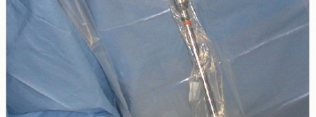 Illustration 11 for Glenoid Bone Graft for Anterior Shoulder Instability: Restore Stability