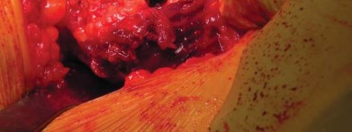 Illustration 49 for Unlock better THA: The technique of short stem for less invasiveness