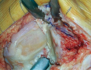 صورة طبية: جراحة استبدال مفصل الركبة الجزئي (UKA): تجنب الأخطاء والاستفادة القصوى في صنعاء مع الأستاذ الدكتور محمد هطيف
