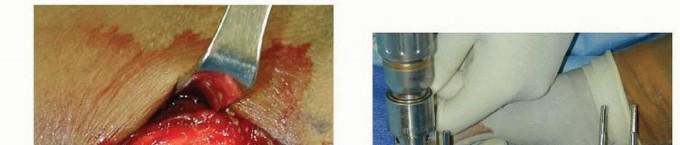 Illustration 22 for Effective K-Wire Fixation: Distal Radius Fractures Without External Fixation
