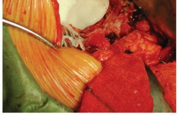 Illustration 21 for Cemented Acetabular Component: Achieving Optimal THA Stability