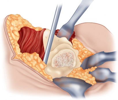 Illustration 50 for Unlock the Figure Posterior Approach to the Hip