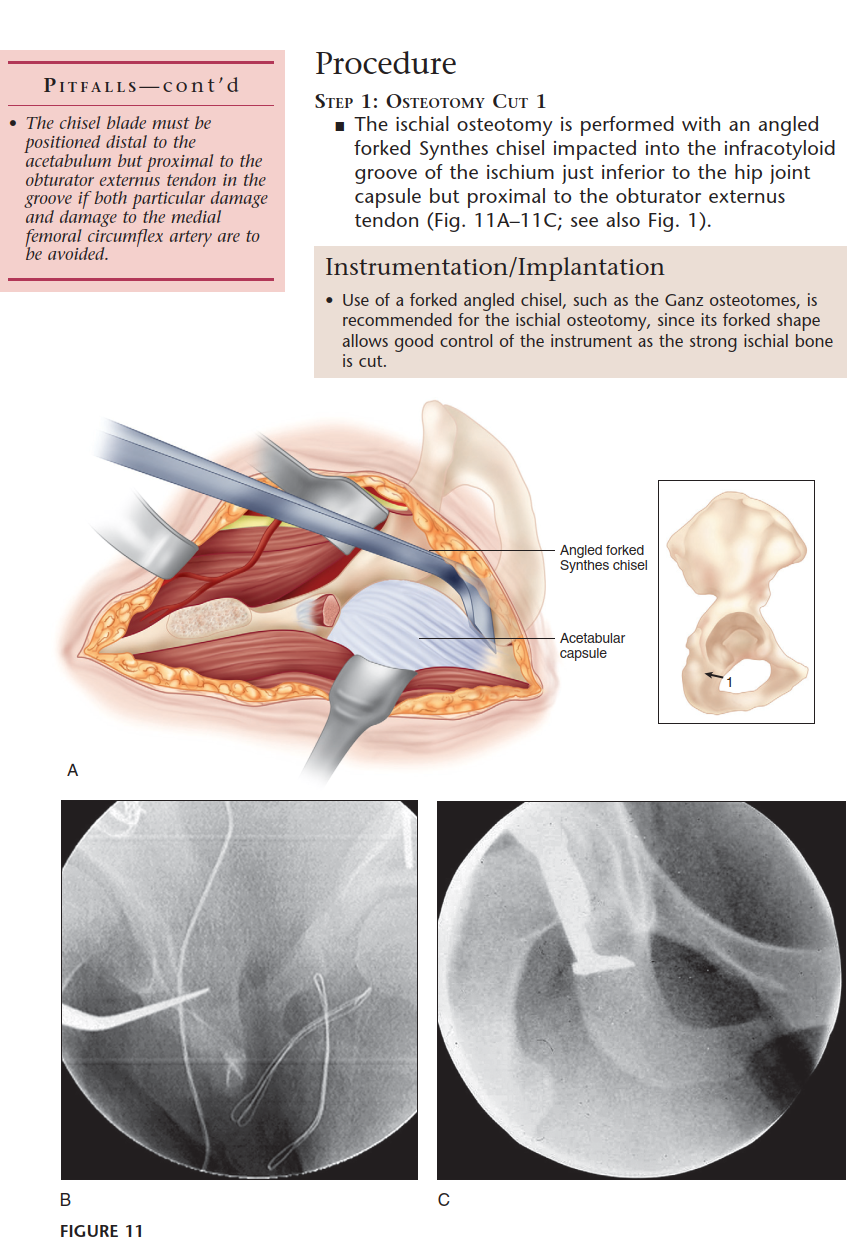 Illustration 25 for Bernese PAO: Unlocking the Procedure with Level V Evidence Insights