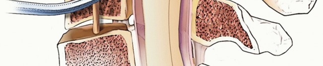 Illustration 24 for Stop Numbness & Instability: Corpectomy and Fusion Guide