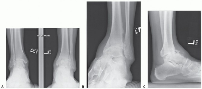 Illustration 19 for Optimize Pain Management with Proximal Ring Block for Ankle Arthrodesis