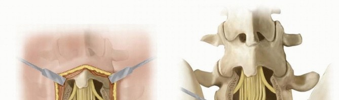 Illustration 15 for Mastering High-Grade Spondylolisthesis: Posterolateral and Interbody Fusion