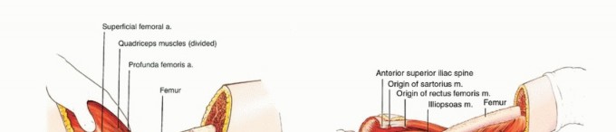 Illustration 26 for Anterior Flap Hemipelvectomy: Leveraging fig tech fig for Difficult Tumors