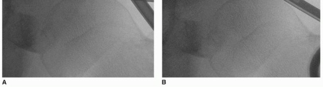 Illustration 23 for Beyond Knee Surg: Hip Arthroscopy for Sports Injuries