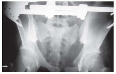 Illustration 7 for Emergency Fixation of the Pelvis: Control Bleeding & Restore Stability