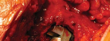 Illustration 24 for S-ROM: Inside the Technique of Modular Implant Design