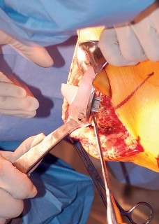 Illustration 17 for Mastering Gap Balancing in Revision TKA: Avoid Common Pitfalls