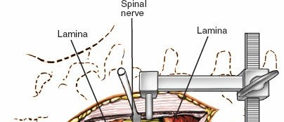 Illustration 21 for Mastering the Spine Posterior Approach: Surgical Essentials