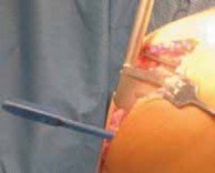 Illustration 16 for Knee Arthroplasty Unicondylar: Discover if Partial Knee Replacement is Right