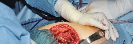 Illustration 39 for Collum Femoris Preserving: Achieve Better Primary Hip Outcomes