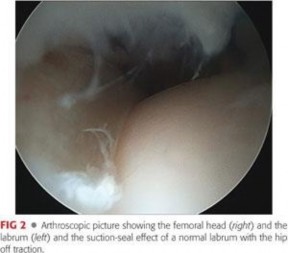Illustration 8 for Precision Hip Arthroscopy: Unlock Access to the Peripheral Compartment