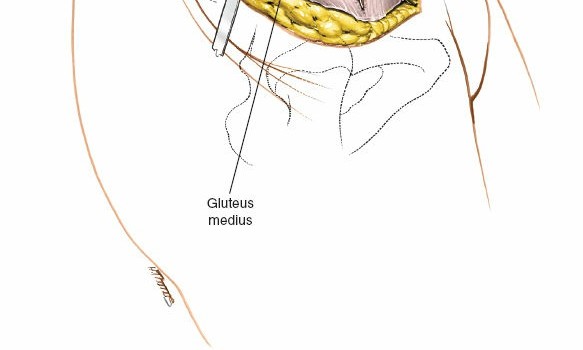 Illustration 30 for Pelvis & Acetabulum Approaches: Unlocking the Posterior Superior Iliac
