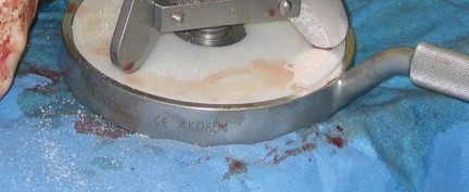 Illustration 14 for Expert Bone Grafting for Primary Total Hip Replacement Success