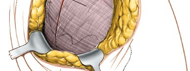 Illustration 38 for Pelvis & Acetabulum Approaches: Unlocking the Posterior Superior Iliac
