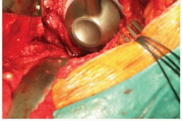 Illustration 12 for Cemented Acetabular Component: Achieving Optimal THA Stability