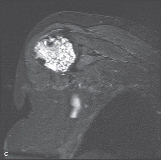 Illustration 3 for Mastering Orthopedics Oncology: Chondrosarcoma Cases