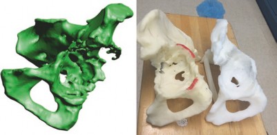 Illustration 3 for How We Tackled Massive Bone Loss in a Revision Hip Arthroplasty